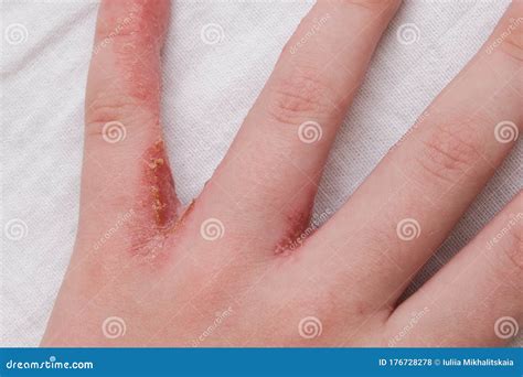 Child Hand Witn Eczema, Atopic Dermatitis between Fingers Stock Photo ...