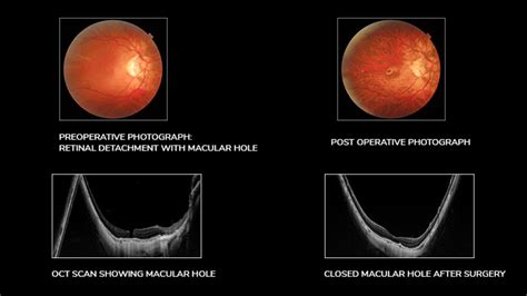 Retinal Tear : Retinal Tears And Detachment Northern Eye Centre / ↓ ...