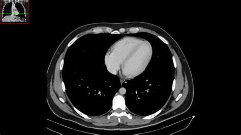 Clavijas Inolvidable Interpretativo tac en los pulmones Refinería ...