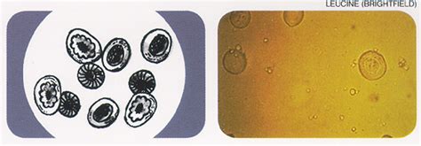 Leucine crystals in Urine | Medical Laboratories