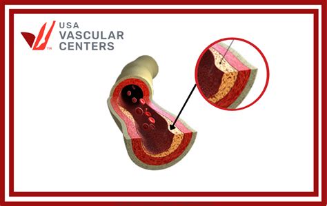 Calcium Deposits and Peripheral Artery Disease (PAD)