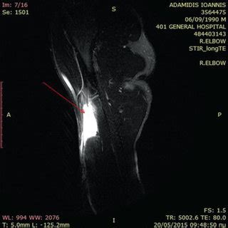 Acute biceps rupture in a military parachutist. Popeye deformity is ...