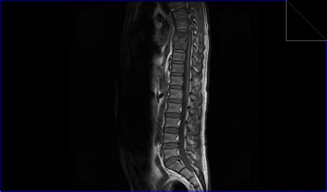 Discitis MRI | Radiology article on how to report Spondylodiscitis