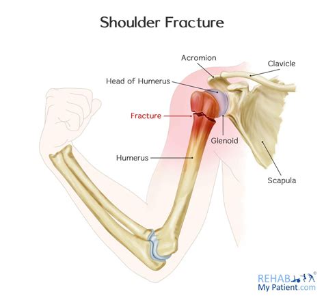 Shoulder Fracture | Rehab My Patient