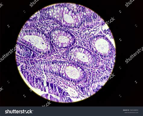 Tubulovillous Adenoma High Grade Dysplasia Colon Stock Photo 1969348093 | Shutterstock