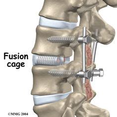 32 Spinal Fusion ideas | spinal fusion, spinal, spinal fusion surgery