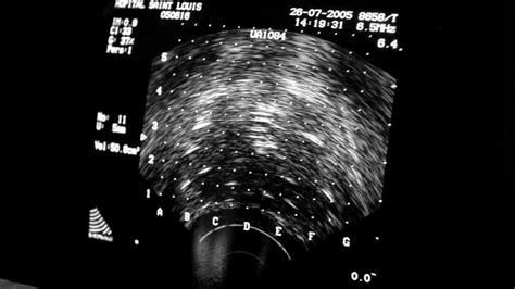 Brachytherapy for cervical cancer