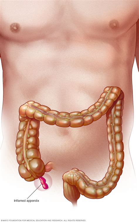 Appendicitis Disease Reference Guide - Drugs.com