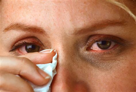 Burning Eyes – Causes of Burning Eyes ~ Living Healthy Life