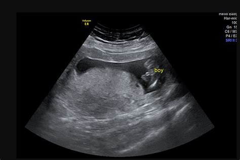 How to Tell Your Baby's Gender from An Ultrasound Picture