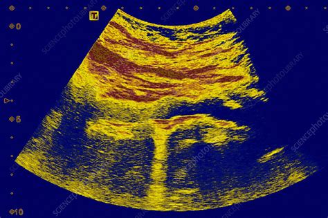 Atheromatous aorta, sonography - Stock Image - C025/4455 - Science Photo Library