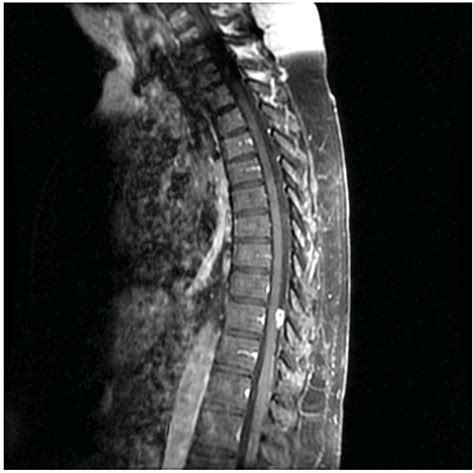 Spinal Cord Compression Due to a Catheter Tip Granuloma of an Intrathecal Morphine Pump ...