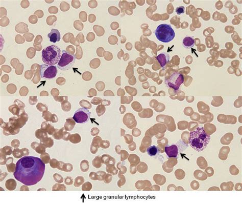 Bone marrow specimen; showing hypocellular bone marrow without... | Download Scientific Diagram