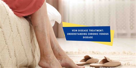 Vein Disease Treatment: Understanding Chronic Venous Disease | OneHealth.sg | Singapore's ...