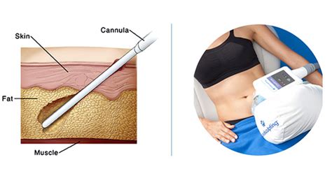 Liposuction vs. CoolSculpting: What Is The Difference & Which is Better?