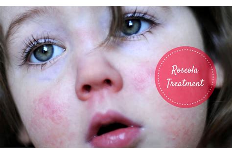 Roseola Rash: Try These Home Remedies To Treat Roseola Virus