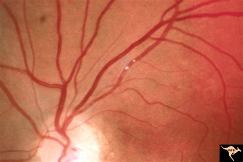 Cerebroretinal Microangiopathy (Susac Syndrome) | Eccles Health ...