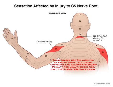 Sensation Affected by Injury to C5 Nerve Root