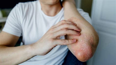 Bacterial Skin Rash - Causes, Remedies, And Treatments Revealed!