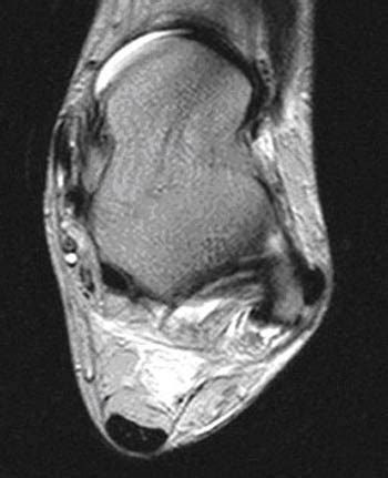 Peroneal Tendon Dislocation and Superior Peroneal Retinaculum Injury ...