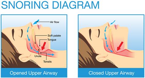 How Does a Snore Pillow Work to Stop Snoring