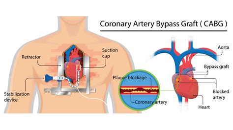 Coronary Artery Bypass Grafting (CABG) | Parkway East Hospital