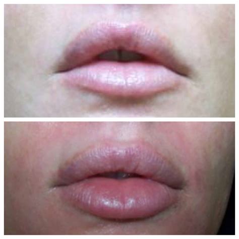 juvederm-lip-augmentation-juvederm-ultra-xc | Radiance Medspa | Avon, Hartford, CT