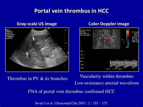 Doppler ultrasound of portal vein thrombosis