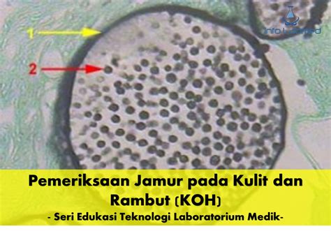 Pemeriksaan Jamur pada Kulit dan Rambut (KOH) | Seri Edukasi Teknologi ...