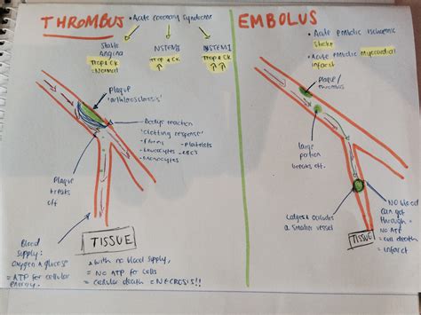 Understanding Thrombus and Embolism