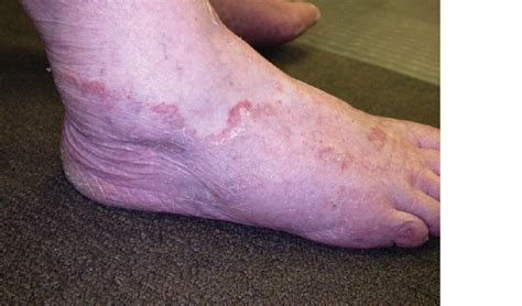 RACGP - Superficial fungal infections