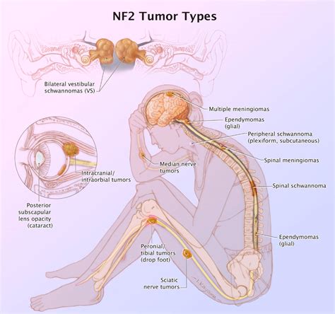 Acoustic Neuroma Causes | Expert Surgeon | Aaron Cohen-Gadol, MD