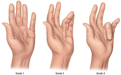 Dupuytren's Contracture - Causes, Symptoms, Treatment