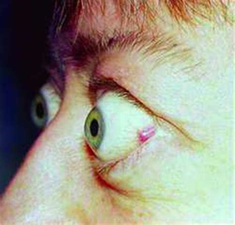 Exophthalmia | definition of exophthalmia by Medical dictionary