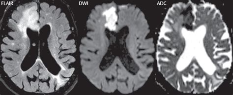 Infarction | Radiology Key