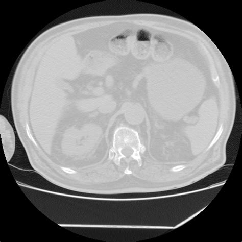 Atoll sign (Radiopaedia 82033-96035 Axial lung window) - NC Commons