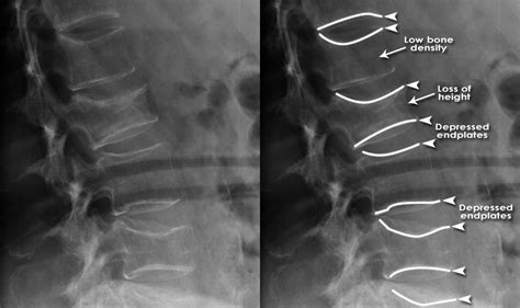Trauma X-ray - Axial skeleton gallery 2 - Lumbar spine - Fractures