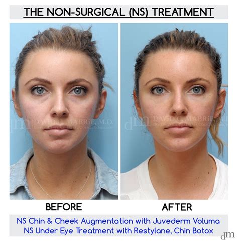 Gorgeous Non-Surgical Before and After result by Dr. David Mabrie! www.yourfaceinourhands.com ...