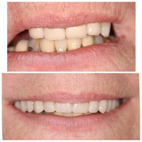 Before and After Photos of Dental Implants and Cosmetic Dentistry