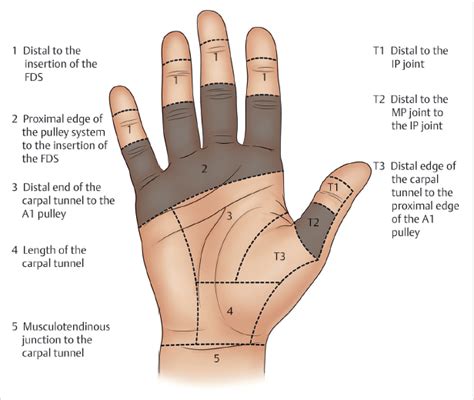 4 Flexor Tendon Repair (Zone 2) | Plastic Surgery Key