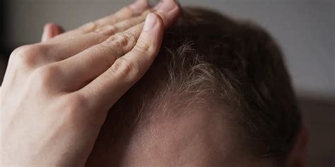 What Is Androgenetic Alopecia? | A Common Hair Loss Condition