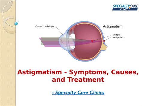 Astigmatism - Symptoms, Causes, and Treatment by Specialty Care Clinics ...