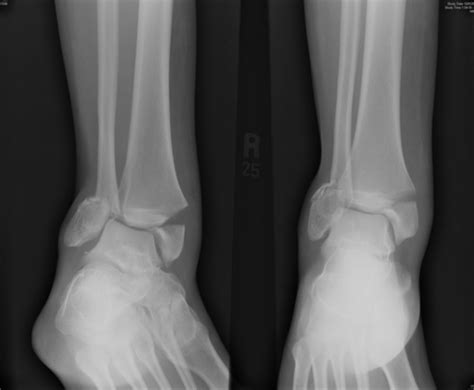 Fall with ankle pain — NUEM Blog