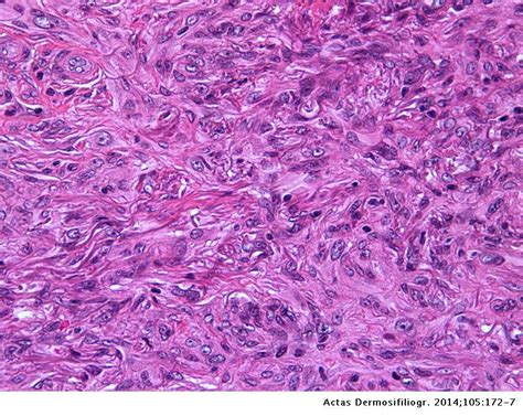 Dermatofibroma of the Face: A Clinicopathologic Study of 20 Cases | Actas Dermo-Sifiliográficas