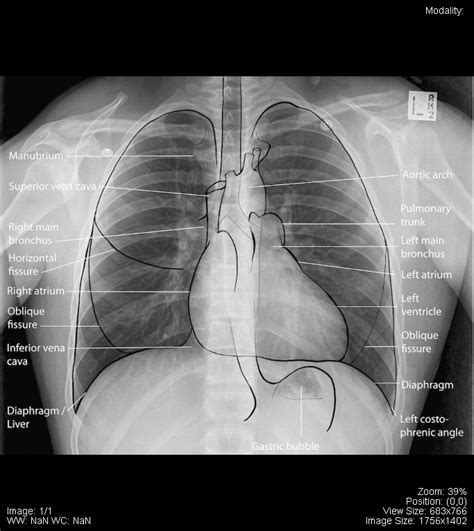 Chest – Undergraduate Diagnostic Imaging Fundamentals