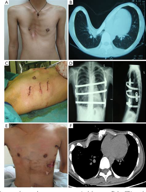 Pectus Excavatum Causes Symptoms Diagnosis Treatment And Complications - Otosection