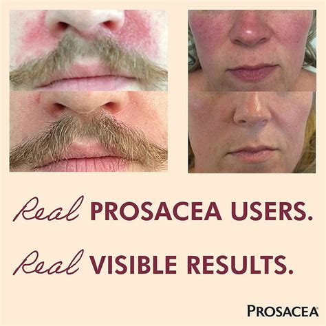 Prosacea UK Medicated Gel Heals Rosacea Symptoms .75 oz — Kingdom States