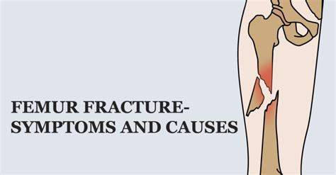 Femur fracture- Symptoms and causes – Welcome to SYS MEDTECH INTERNATIONAL PRIVATE LIMITED