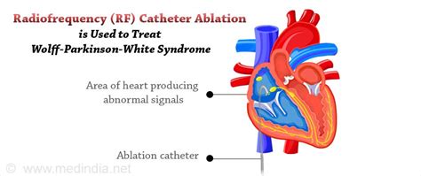 Wolff-Parkinson-White Syndrome (WPW) - Causes, Symptoms, Diagnosis, Treatment & Prevention