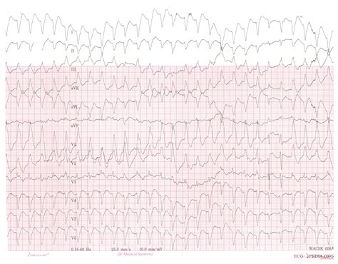 Ventricular tachycardia diagnosis - wikidoc